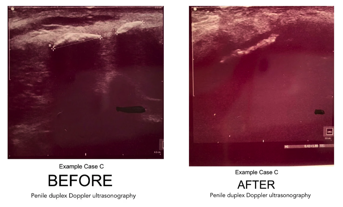 Technology Peyronie's Disease Breakthrough